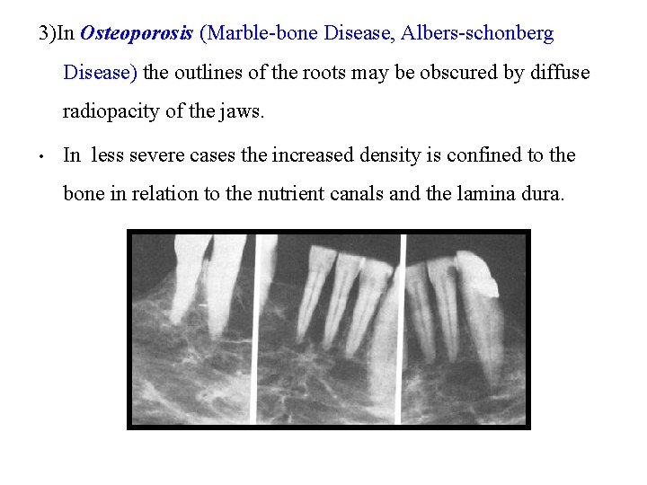 3)In Osteoporosis (Marble-bone Disease, Albers-schonberg Disease) the outlines of the roots may be obscured