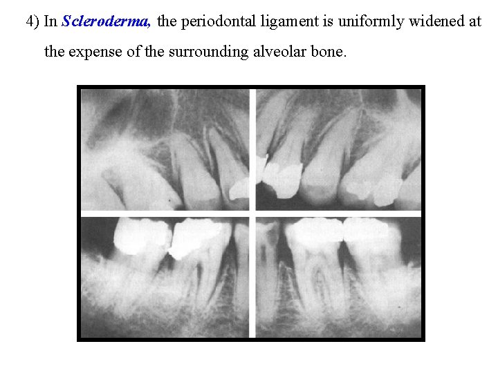 4) In Scleroderma, the periodontal ligament is uniformly widened at the expense of the