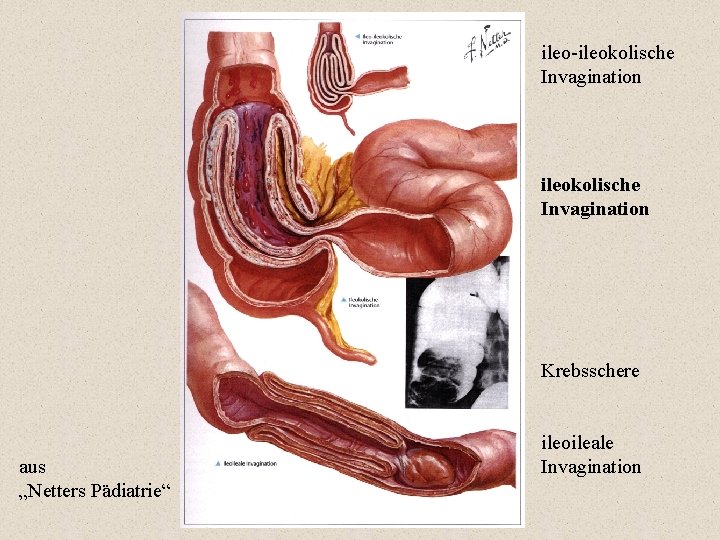 ileo-ileokolische Invagination Krebsschere aus „Netters Pädiatrie“ ileoileale Invagination 