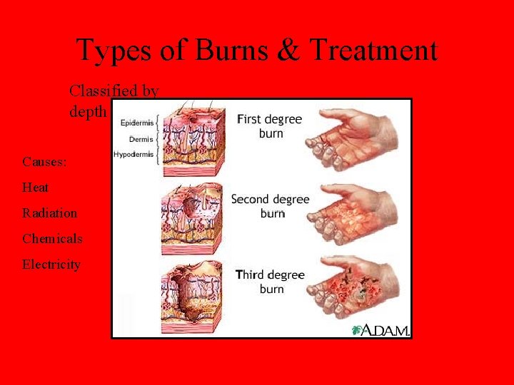 Types of Burns & Treatment Classified by depth Causes: Heat Radiation Chemicals Electricity 