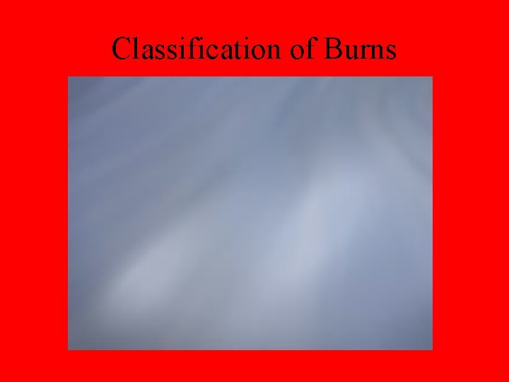 Classification of Burns 