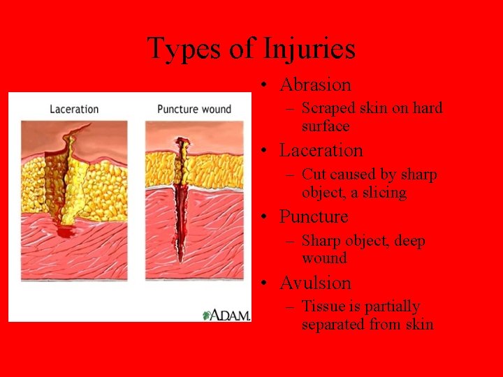 Types of Injuries • Abrasion – Scraped skin on hard surface • Laceration –