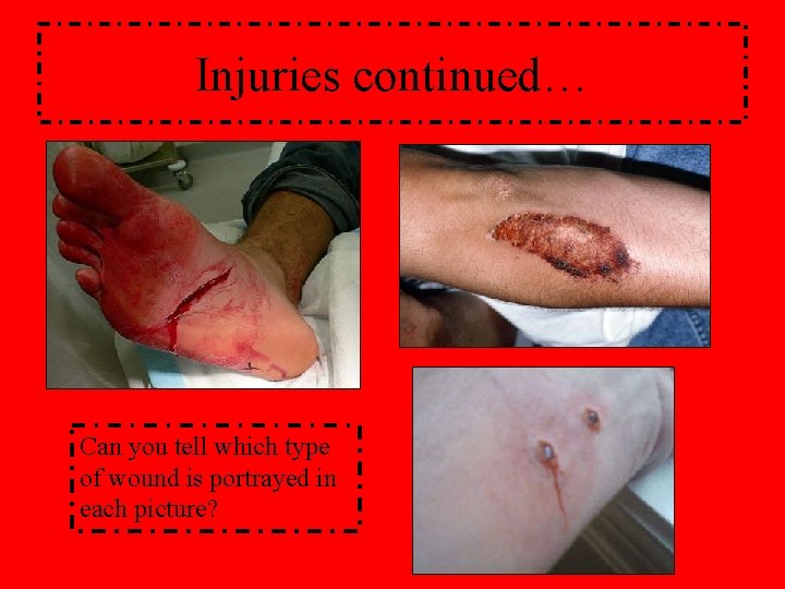 Injuries continued… Can you tell which type of wound is portrayed in each picture?