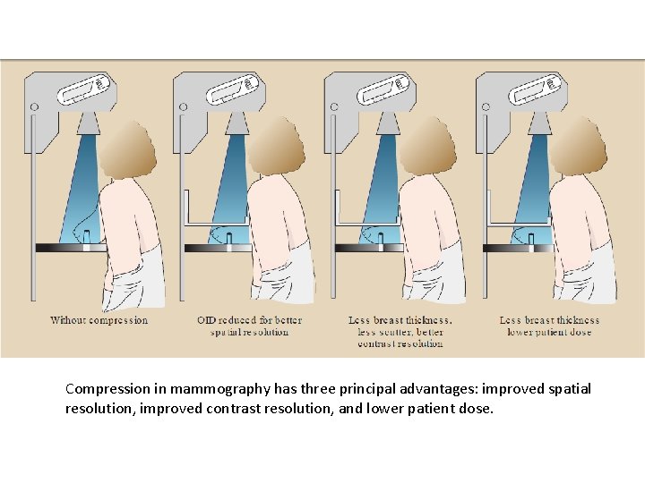 Compression in mammography has three principal advantages: improved spatial resolution, improved contrast resolution, and