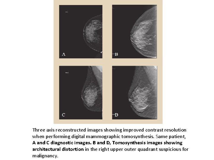 Three axis reconstructed images showing improved contrast resolution when performing digital mammographic tomosynthesis. Same