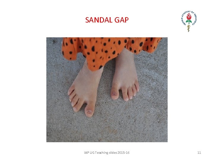 SANDAL GAP IAP UG Teaching slides 2015 -16 11 
