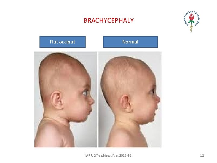 BRACHYCEPHALY Flat occiput Normal IAP UG Teaching slides 2015 -16 12 