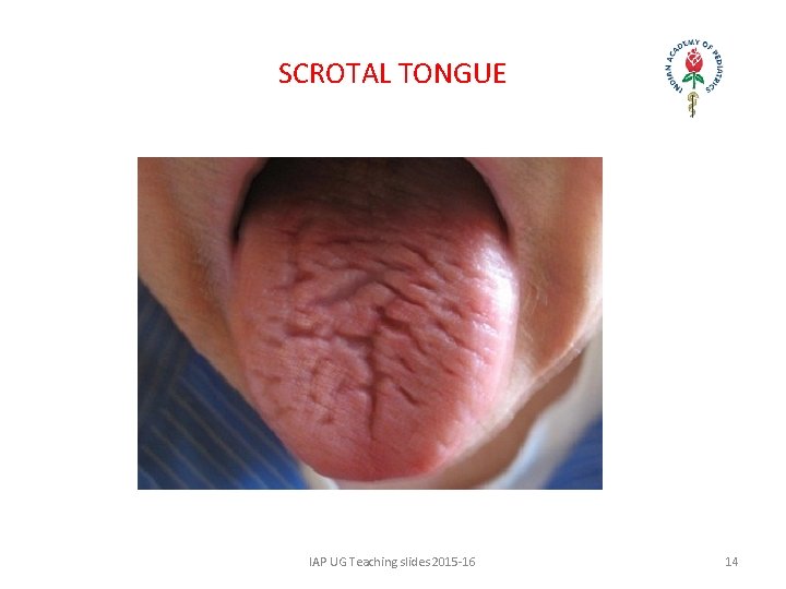 SCROTAL TONGUE IAP UG Teaching slides 2015 -16 14 