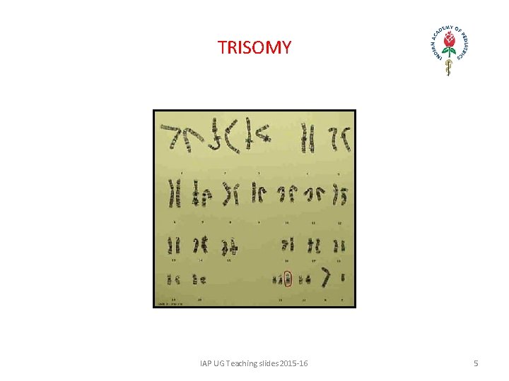TRISOMY IAP UG Teaching slides 2015 -16 5 