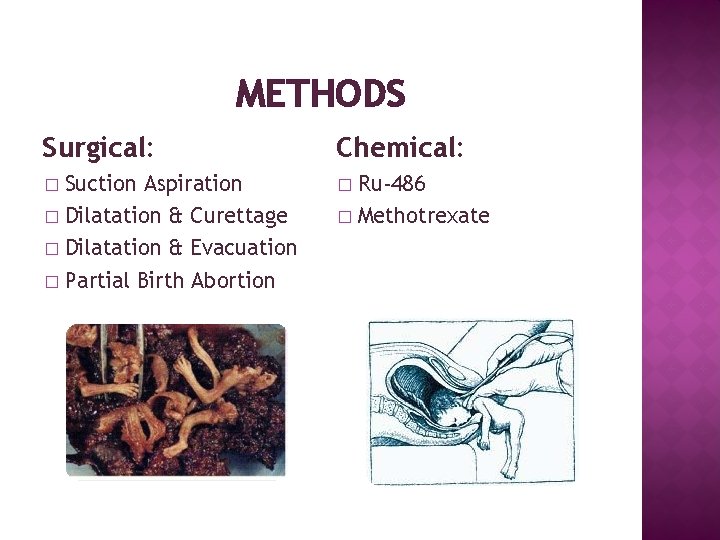 METHODS Surgical: Chemical: Suction Aspiration � Dilatation & Curettage � Dilatation & Evacuation �