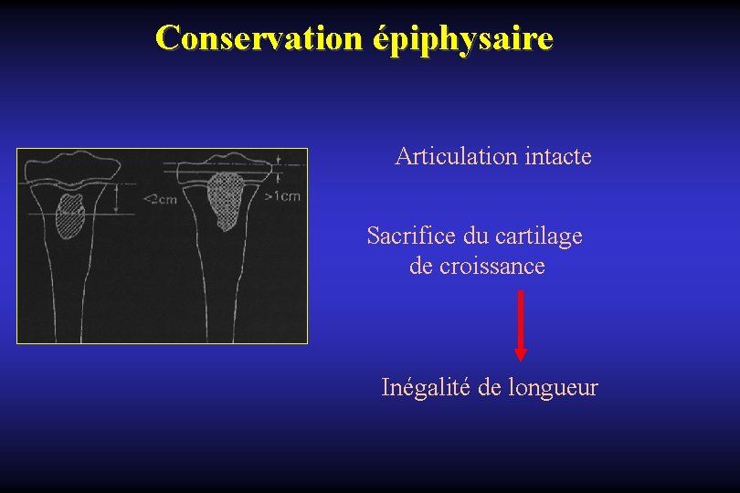 Conservation épiphysaire Articulation intacte Sacrifice du cartilage de croissance Inégalité de longueur 