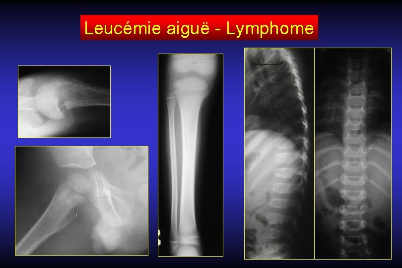 Leucémie aiguë - Lymphome 