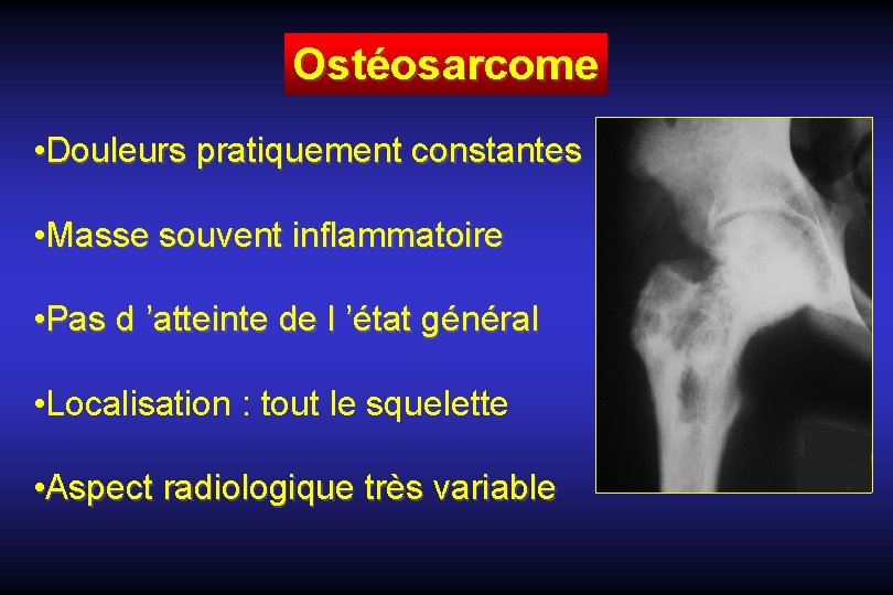 Ostéosarcome • Douleurs pratiquement constantes • Masse souvent inflammatoire • Pas d ’atteinte de