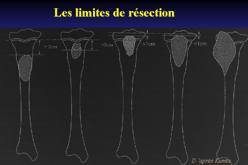 Les limites de résection D ’après Kumta 