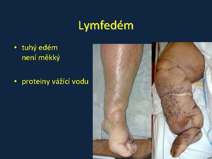 Lymfedém • tuhý edém není měkký • proteiny vážící vodu 