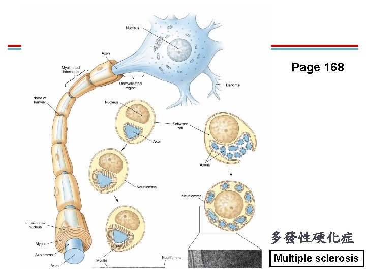 Page 168 多發性硬化症 Multiple sclerosis Page 168 多發性硬化症 Multiple sclerosis