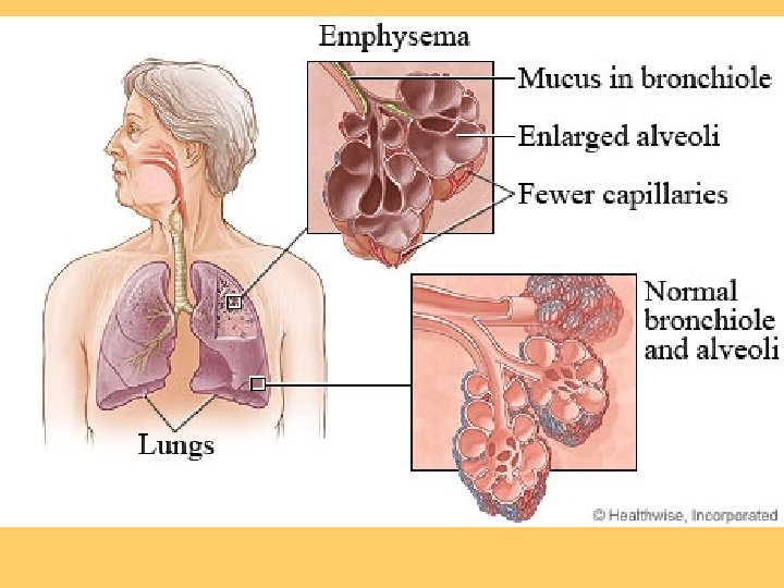 mesothelioma missouri workers compensation