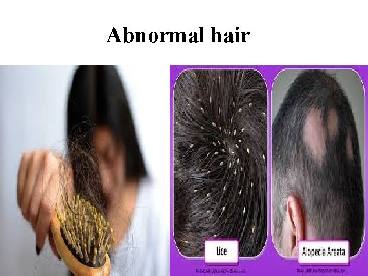 Abnormal hair 