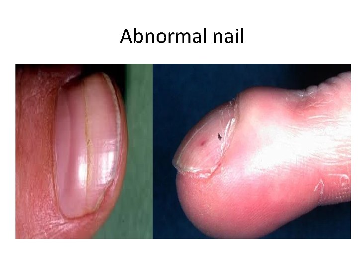 Abnormal nail 