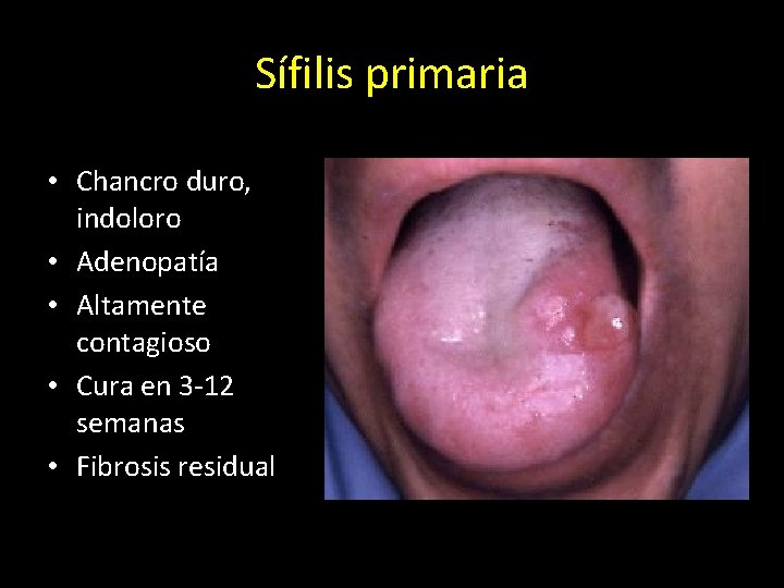 Sífilis primaria • Chancro duro, indoloro • Adenopatía • Altamente contagioso • Cura en