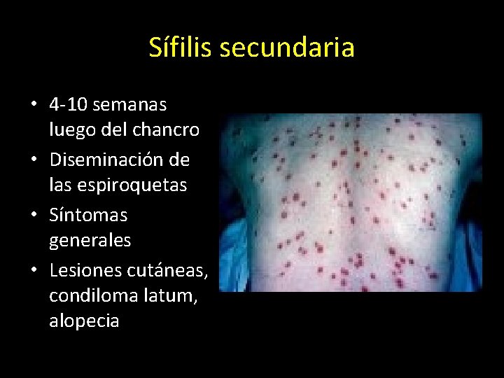 Sífilis secundaria • 4 -10 semanas luego del chancro • Diseminación de las espiroquetas