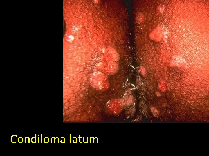 Condiloma latum 