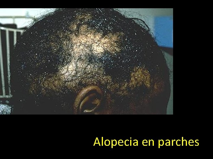 Alopecia en parches 