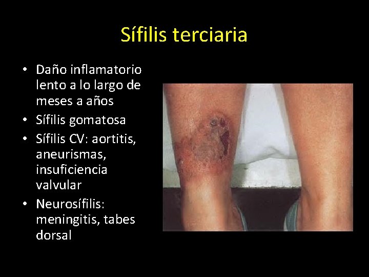 Sífilis terciaria • Daño inflamatorio lento a lo largo de meses a años •