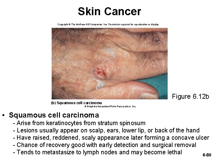 Skin Cancer Copyright © The Mc. Graw-Hill Companies, Inc. Permission required for reproduction or