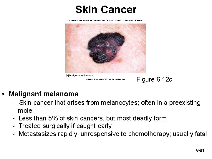 Skin Cancer Copyright © The Mc. Graw-Hill Companies, Inc. Permission required for reproduction or