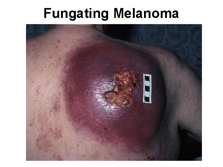 Fungating Melanoma 
