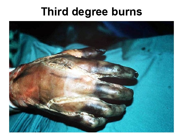 Third degree burns 