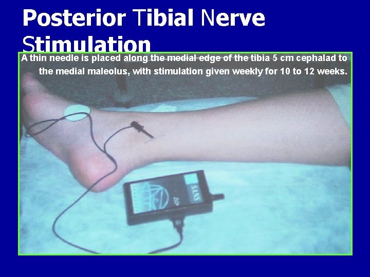 Posterior Tibial Nerve S timulation A thin needle is placed along the medial edge
