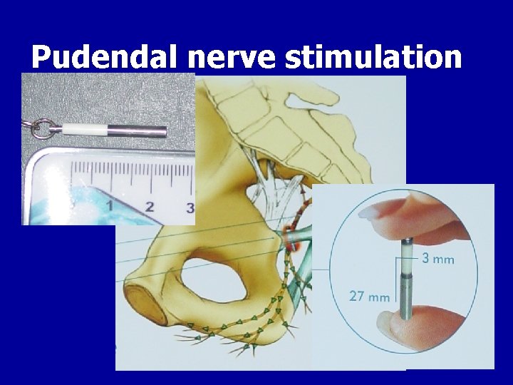 Pudendal nerve stimulation 