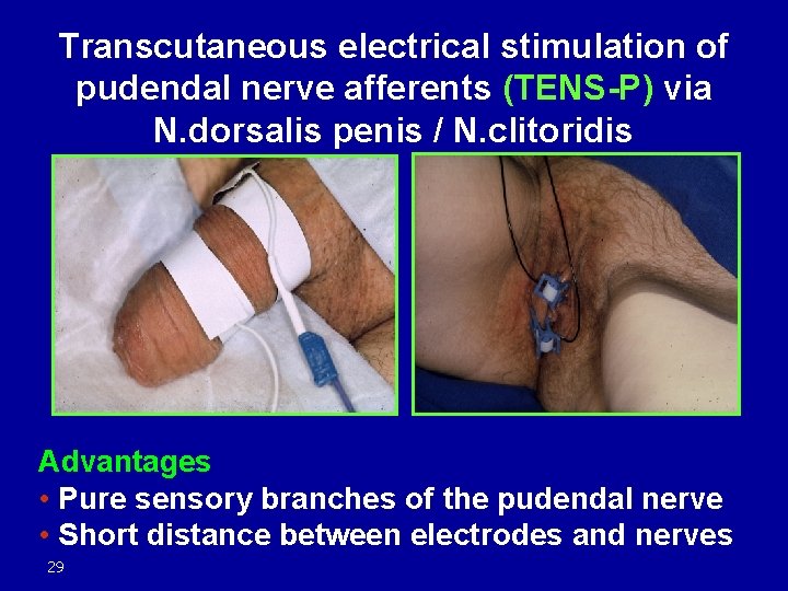 Transcutaneous electrical stimulation of pudendal nerve afferents (TENS-P) via N. dorsalis penis / N.