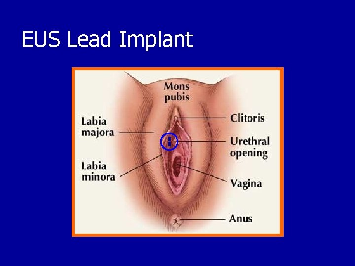 EUS Lead Implant 