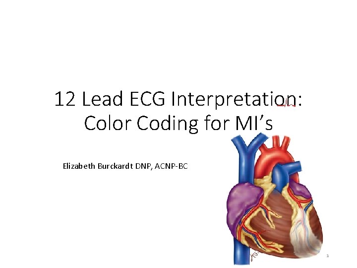 12 Lead ECG Interpretation: Color Coding for MI’s Elizabeth Burckardt DNP, ACNP-BC 1 