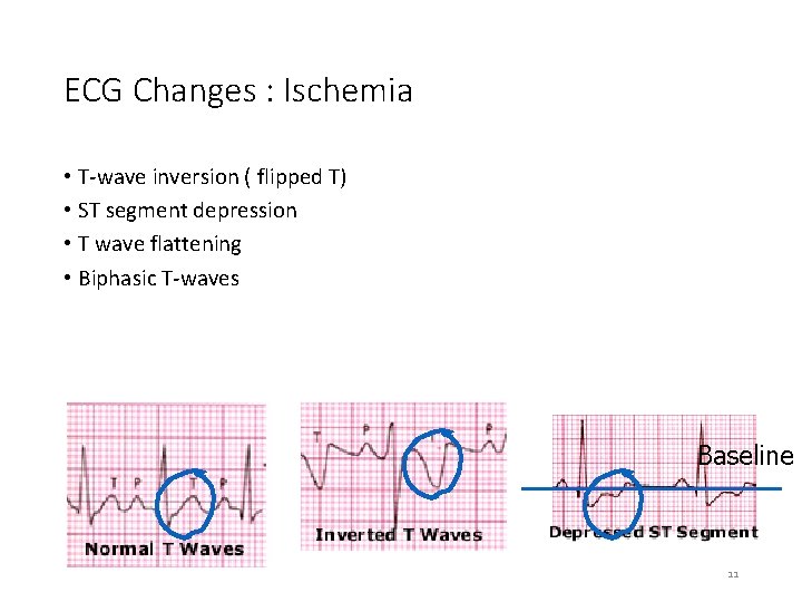 ECG Changes : Ischemia • T-wave inversion ( flipped T) • ST segment depression