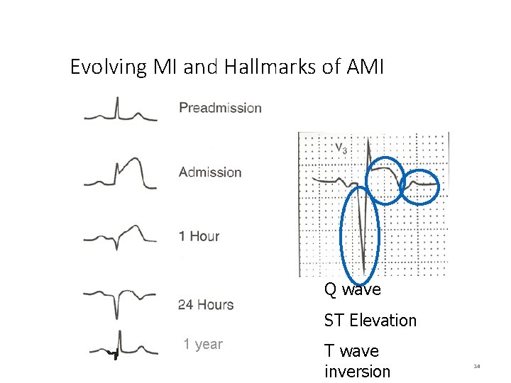 Evolving MI and Hallmarks of AMI Q wave ST Elevation 1 year T wave