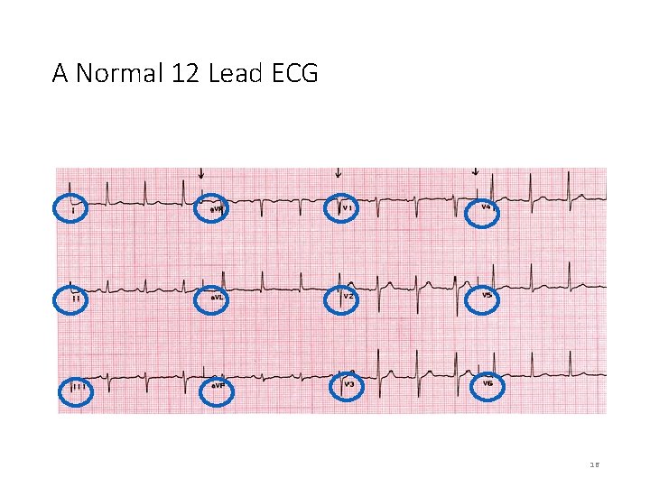 A Normal 12 Lead ECG 16 