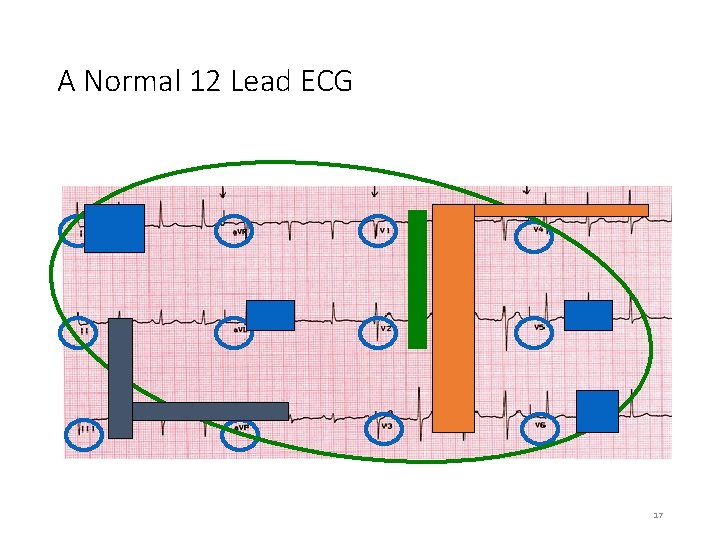 A Normal 12 Lead ECG 17 