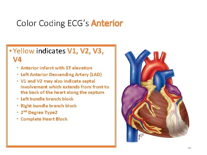 Color Coding ECG’s Anterior • Yellow indicates V 1, V 2, V 3, V