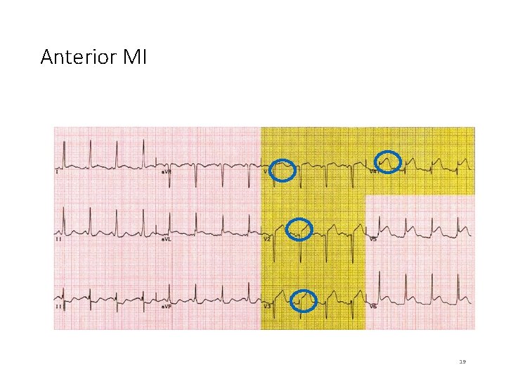 Anterior MI 19 