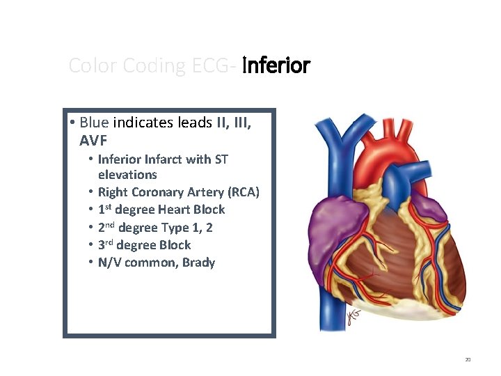 Color Coding ECG- Inferior • Blue indicates leads II, III, AVF • Inferior Infarct