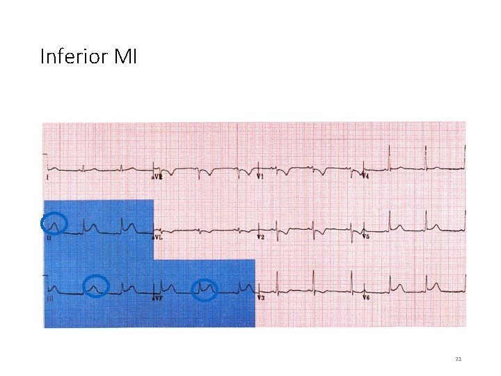 Inferior MI 21 