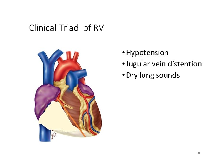 Clinical Triad of RVI • Hypotension • Jugular vein distention • Dry lung sounds