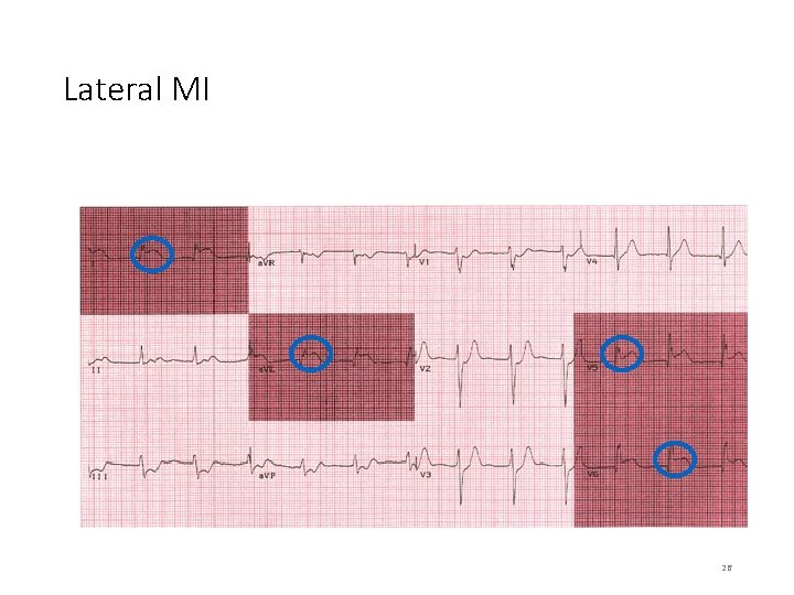 Lateral MI 26 