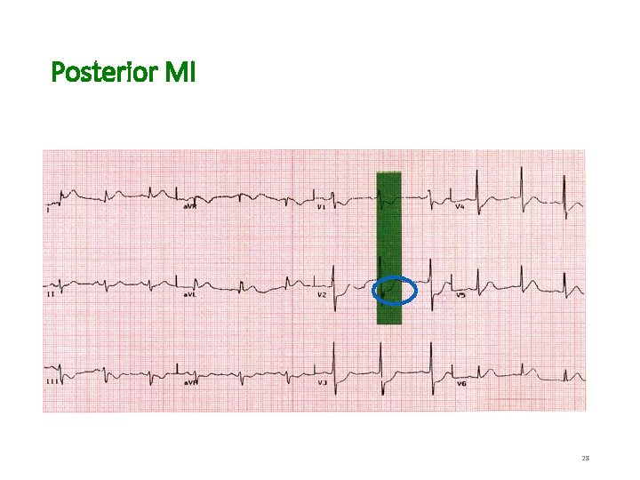 Posterior MI 28 