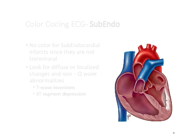 Color Coding ECG- Sub. Endo • No color for Sub. Endocardial infarcts since they