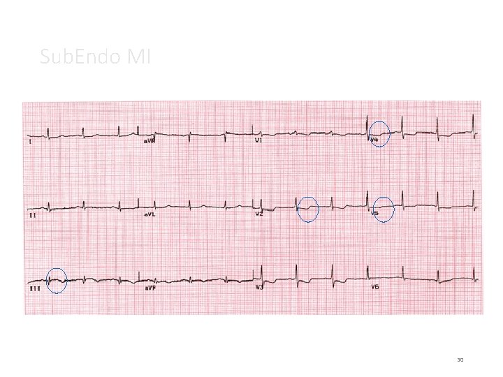 Sub. Endo MI 30 